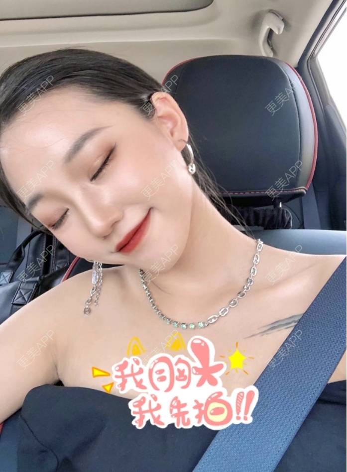 更美 - 微尔的手术缩鼻头经验 | 肋软骨隆鼻 | 手术缩鼻头 | 鼻小柱延长
