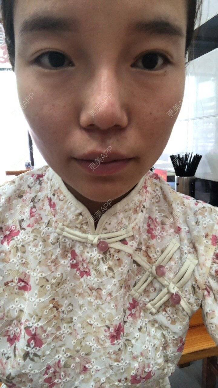 更美 - 旧时光是个大美人儿的除皱瘦脸经验 | 除皱瘦脸 | 玻尿酸下巴 | 杭州