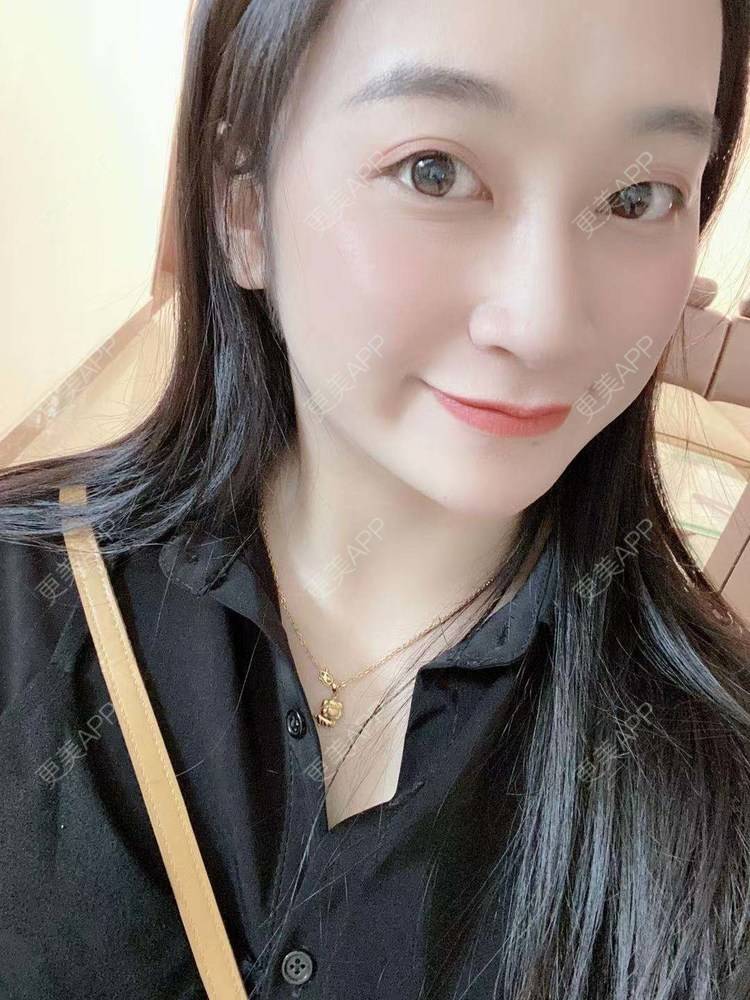 更美 - 更美用户129LF9Yh6a的玻尿酸下巴经验 | 广州 | 视频日记 | 玻尿酸下巴