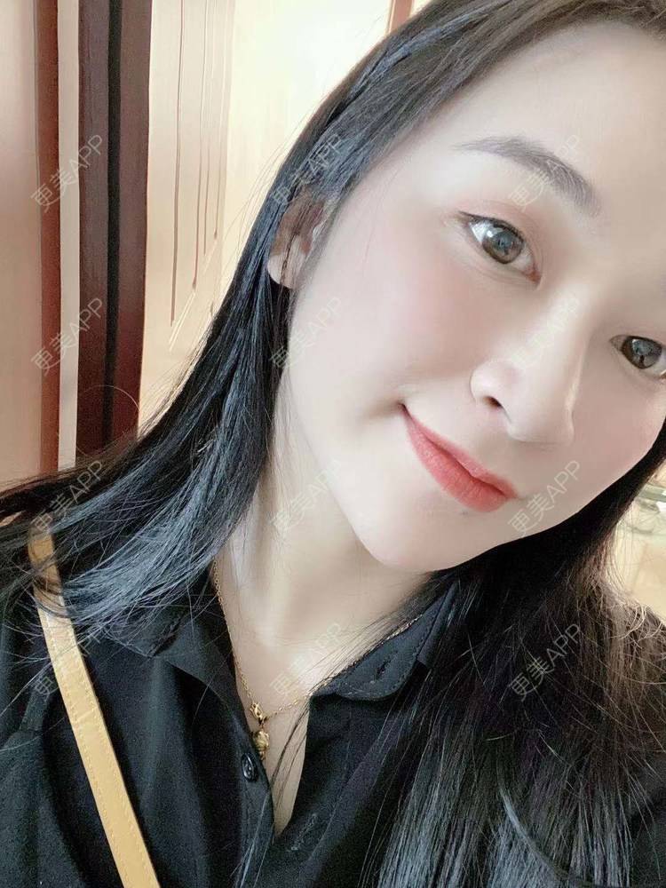 更美 - 更美用户129LF9Yh6a的玻尿酸下巴经验 | 广州 | 视频日记 | 玻尿酸下巴