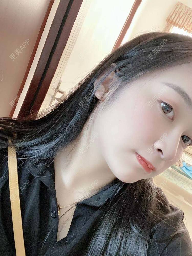 更美 - 更美用户129LF9Yh6a的玻尿酸下巴经验 | 广州 | 视频日记 | 玻尿酸下巴