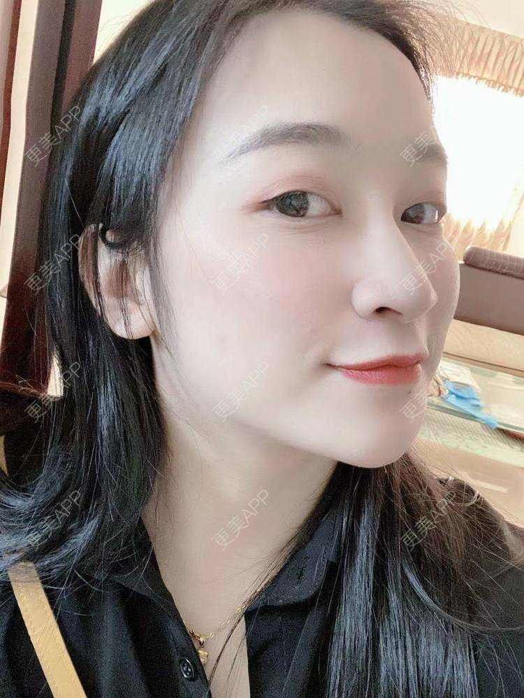 更美 - 更美用户129LF9Yh6a的玻尿酸下巴经验 | 广州 | 视频日记 | 玻尿酸下巴