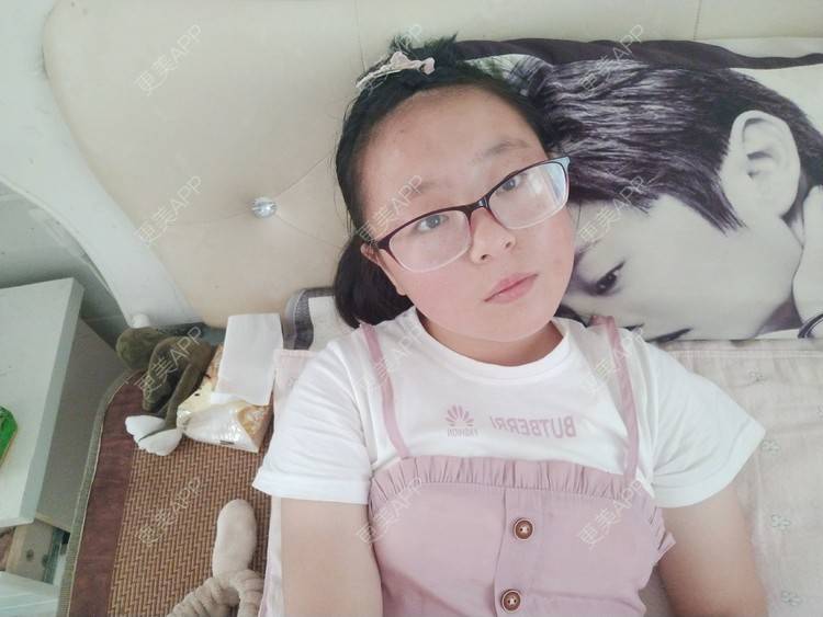 更美 - 更美用户9RTVHRORg7的双眼皮经验 | 双眼皮