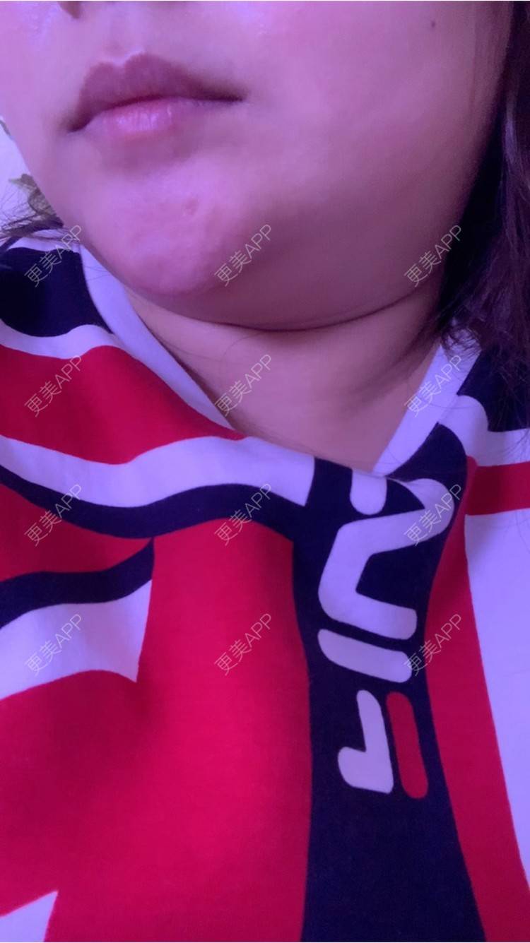 更美 - 更美用户KiObFxgNkw的玻尿酸下巴经验 | 玻尿酸下巴 | 重庆