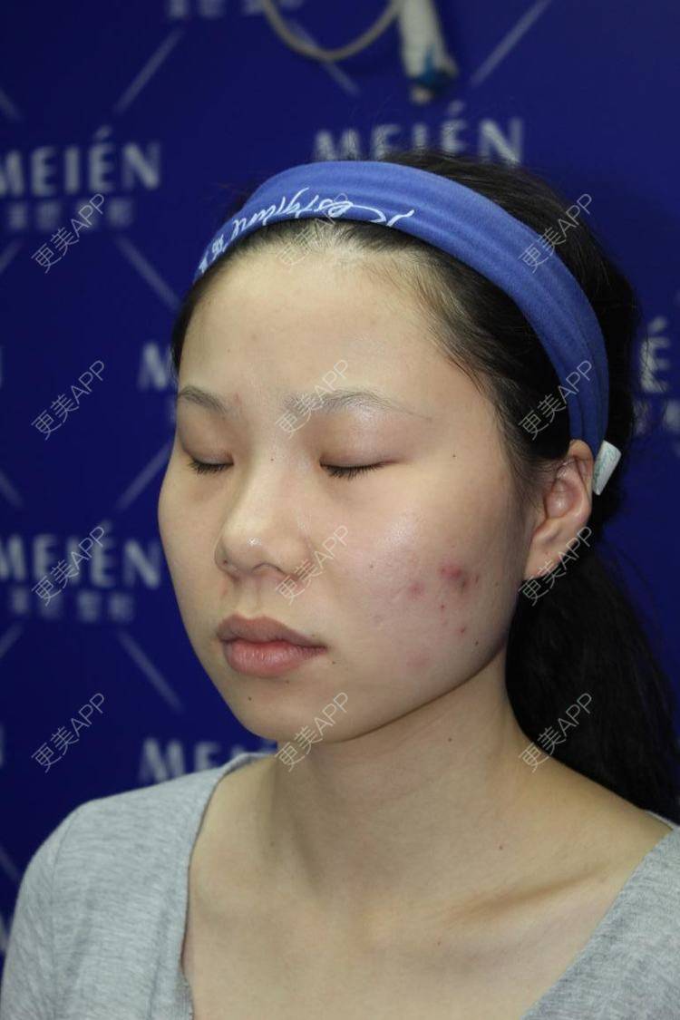 更美 - 天使爱美丽1的下颌角切除经验 | 广州 | 视频日记 | 下颌角切除