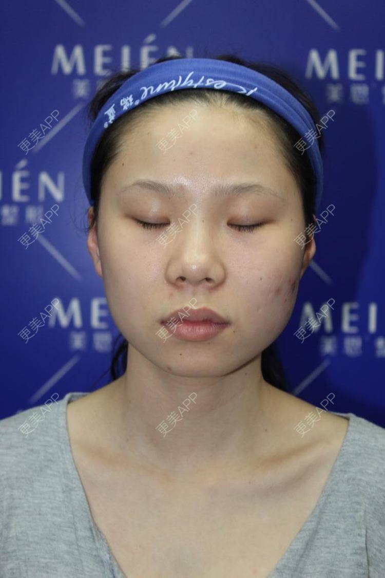 更美 - 天使爱美丽1的下颌角切除经验 | 广州 | 视频日记 | 下颌角切除