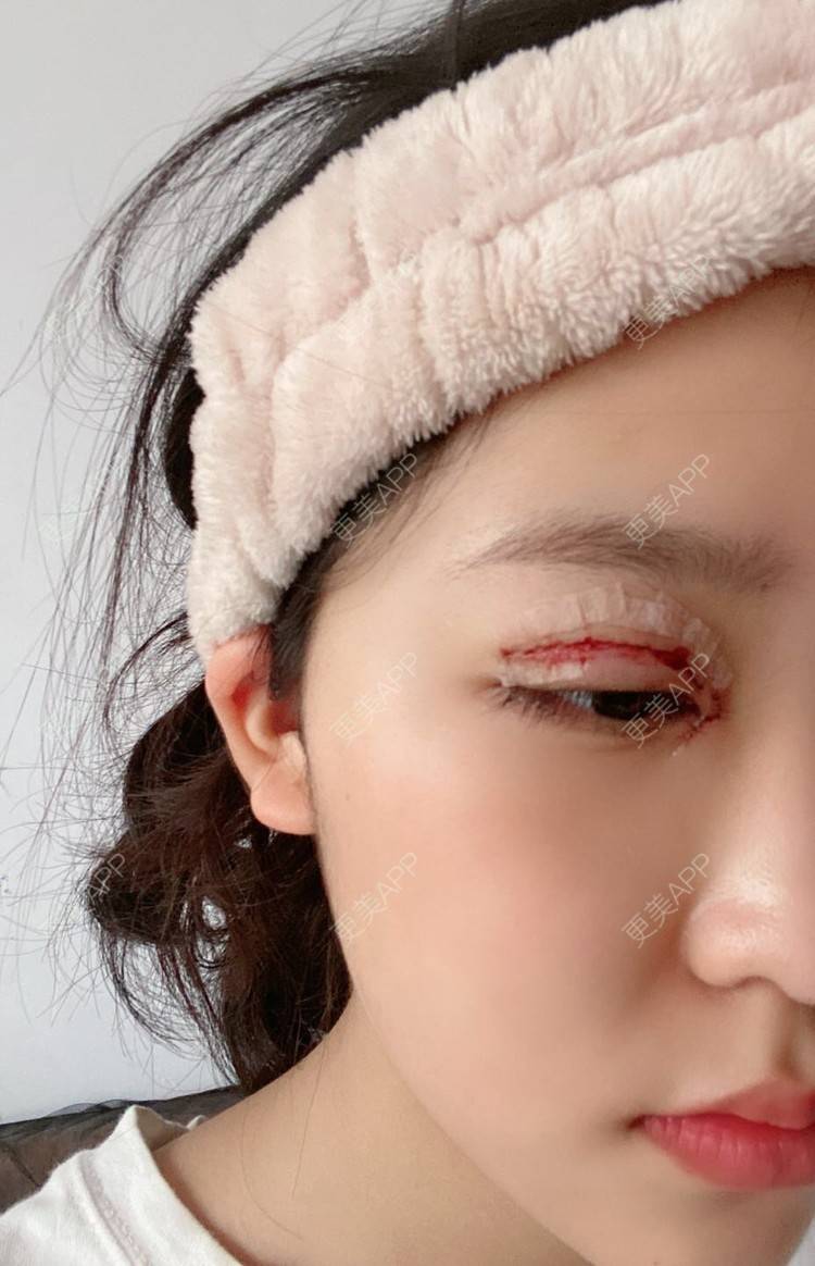 更美 - 更美用户zgnbj8eacd的全切双眼皮日记 | 全切双眼皮 | 开内