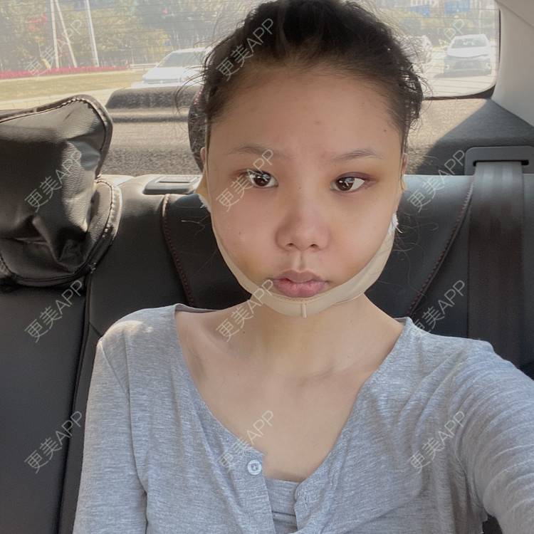 更美 - 天使爱美丽1的下颌角切除经验 | 广州 | 视频日记 | 下颌角切除