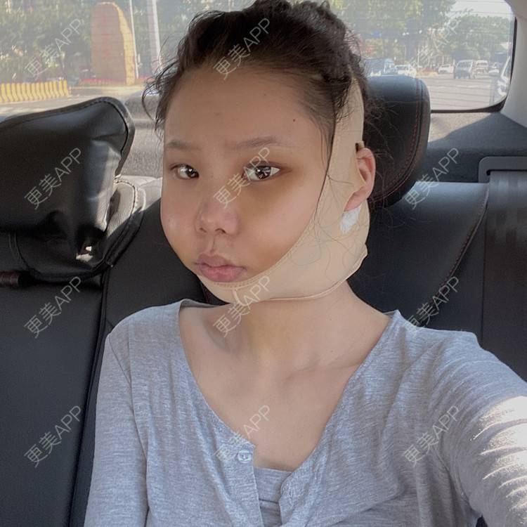 更美 - 天使爱美丽1的下颌角切除经验 | 广州 | 视频日记 | 下颌角切除