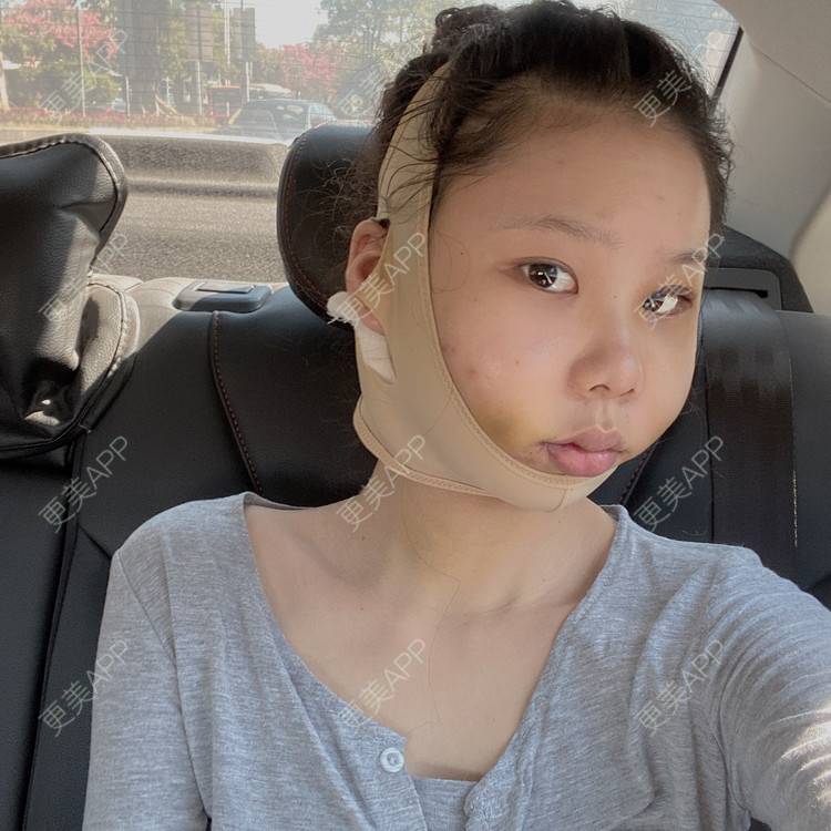 更美 - 天使爱美丽1的下颌角切除经验 | 广州 | 视频日记 | 下颌角切除