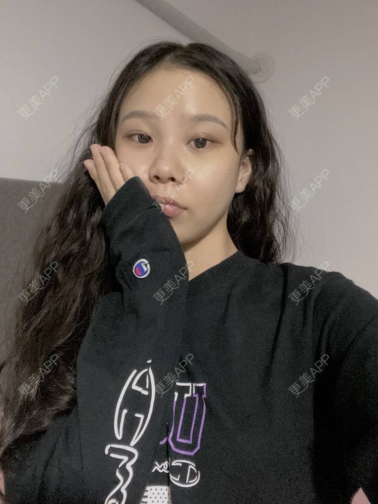 更美 - 天使爱美丽1的下颌角切除经验 | 广州 | 视频日记 | 下颌角切除
