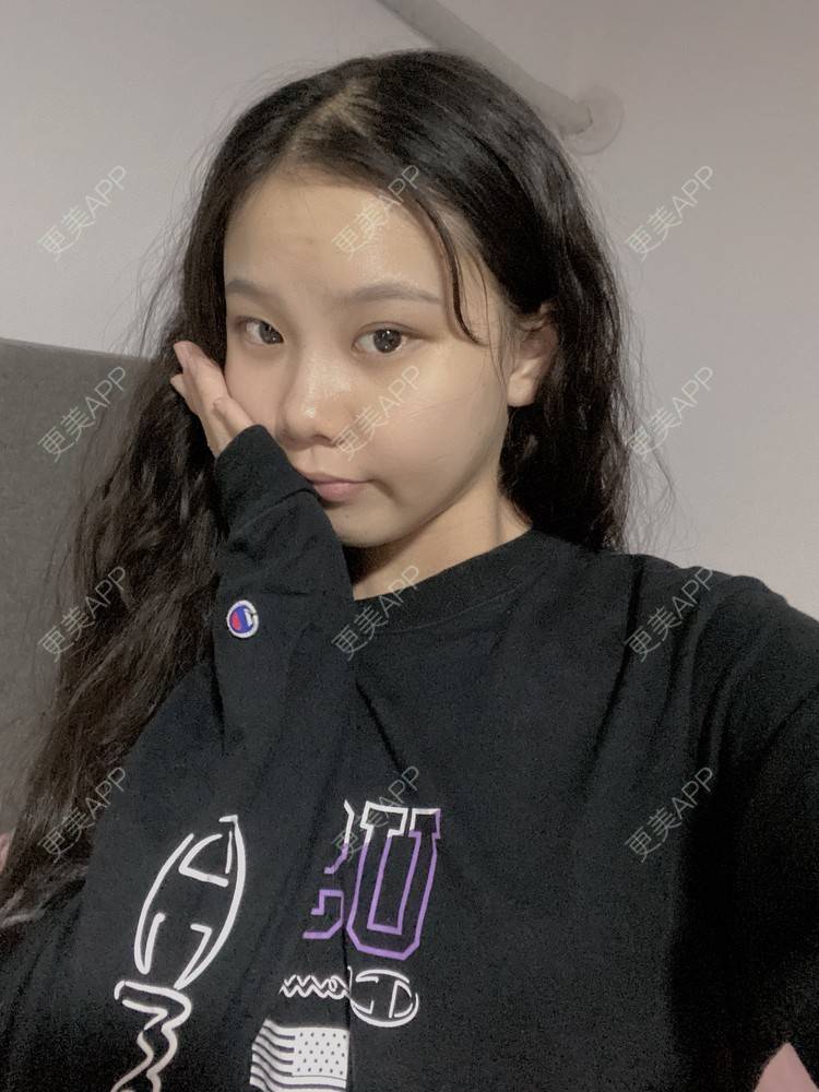 更美 - 天使爱美丽1的下颌角切除经验 | 广州 | 视频日记 | 下颌角切除