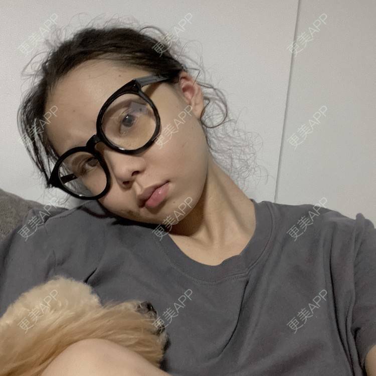 更美 - 天使爱美丽1的下颌角切除经验 | 广州 | 视频日记 | 下颌角切除