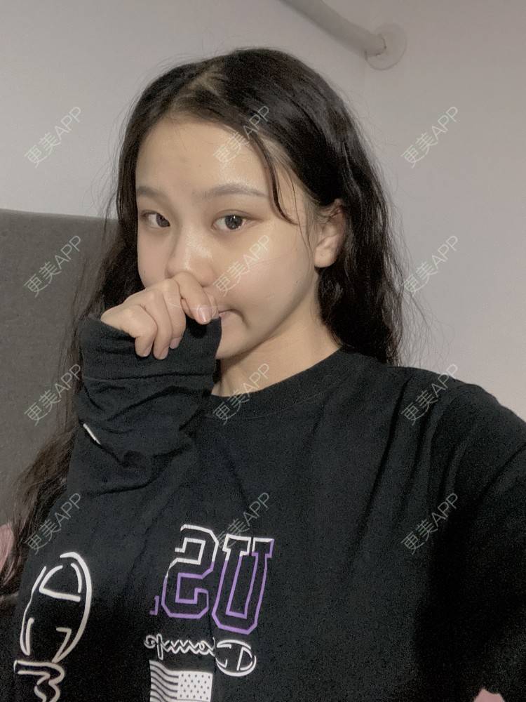 更美 - 天使爱美丽1的下颌角切除经验 | 广州 | 视频日记 | 下颌角切除
