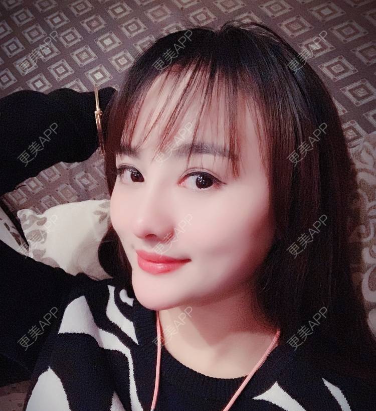 更美 - 更美用户tYzlahBO6T的植发际线经验 | 植发际线 | 深圳 | 毛发移植