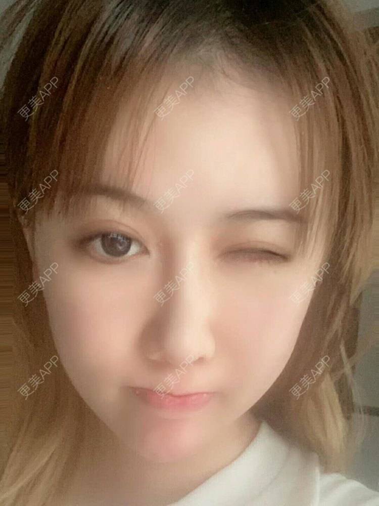 更美 - 佳佳SJ的鼻部多项经验 | 上海 | 视频日记 | 鼻部多项