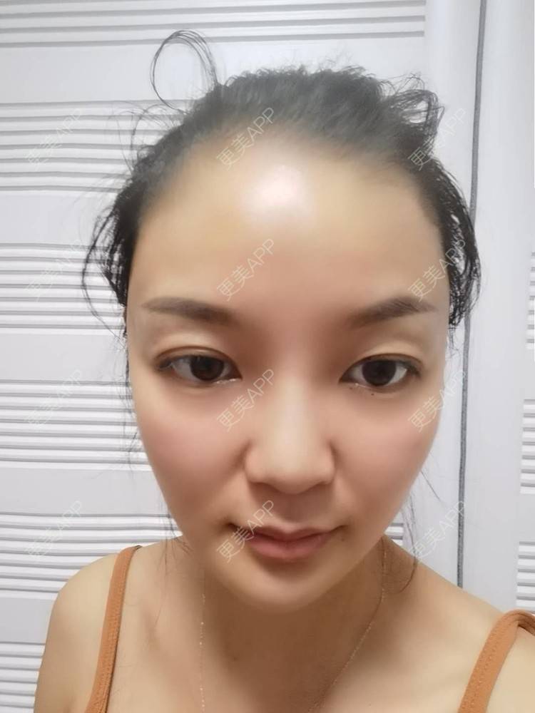 更美 - 水里的一条鱼的丰胸（隆胸）经验 | 自体脂肪隆胸 | 胶原蛋白丰胸 | 乳房再造 | 胸部下垂矫正 | 丰胸（隆胸） | 假体隆胸 | 玻尿酸隆胸