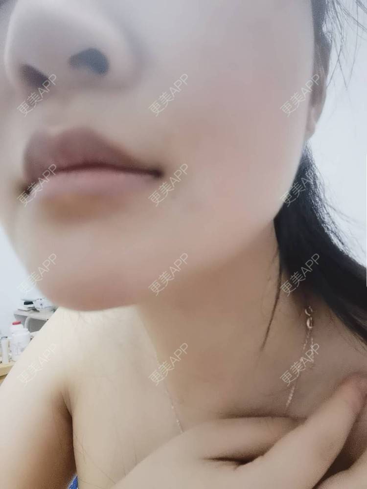 更美 - 水里的一条鱼的丰胸（隆胸）经验 | 自体脂肪隆胸 | 胶原蛋白丰胸 | 乳房再造 | 胸部下垂矫正 | 丰胸（隆胸） | 假体隆胸 | 玻尿酸隆胸