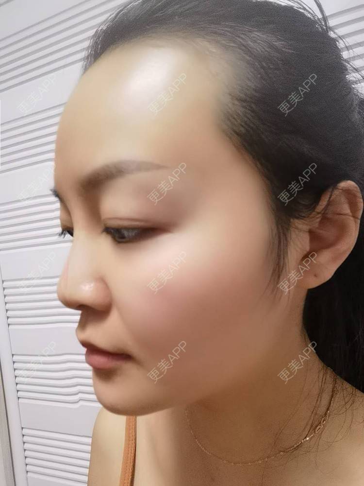 更美 - 水里的一条鱼的丰胸（隆胸）经验 | 自体脂肪隆胸 | 胶原蛋白丰胸 | 乳房再造 | 胸部下垂矫正 | 丰胸（隆胸） | 假体隆胸 | 玻尿酸隆胸