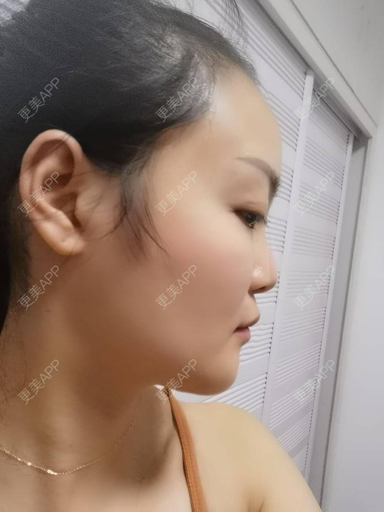 更美 - 水里的一条鱼的丰胸（隆胸）经验 | 自体脂肪隆胸 | 胶原蛋白丰胸 | 乳房再造 | 胸部下垂矫正 | 丰胸（隆胸） | 假体隆胸 | 玻尿酸隆胸