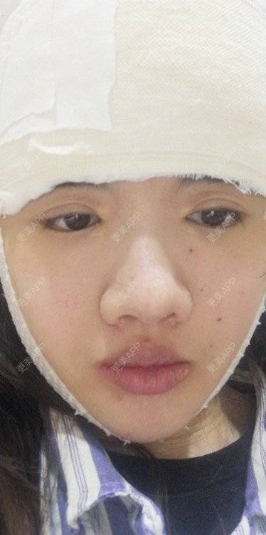 更美 - 更美用户e2aBOUZcGZ的额头经验 | 额头 | 硅胶丰额头 | 太阳穴 | 硅胶丰太阳穴