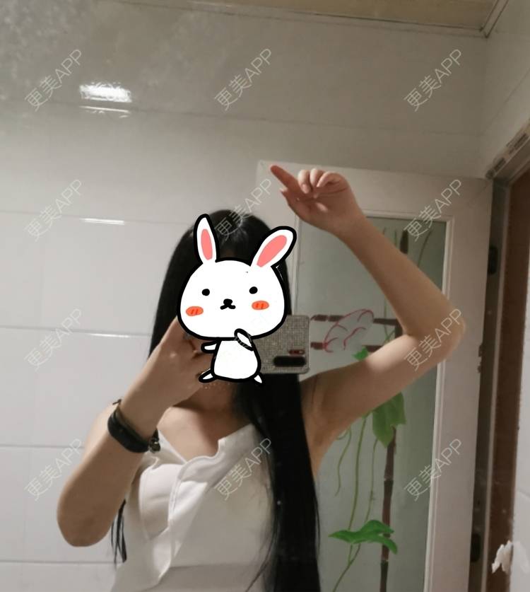 更美 - 更美用户jHjijlJNxV的手臂吸脂经验 | 手臂吸脂 | 广州