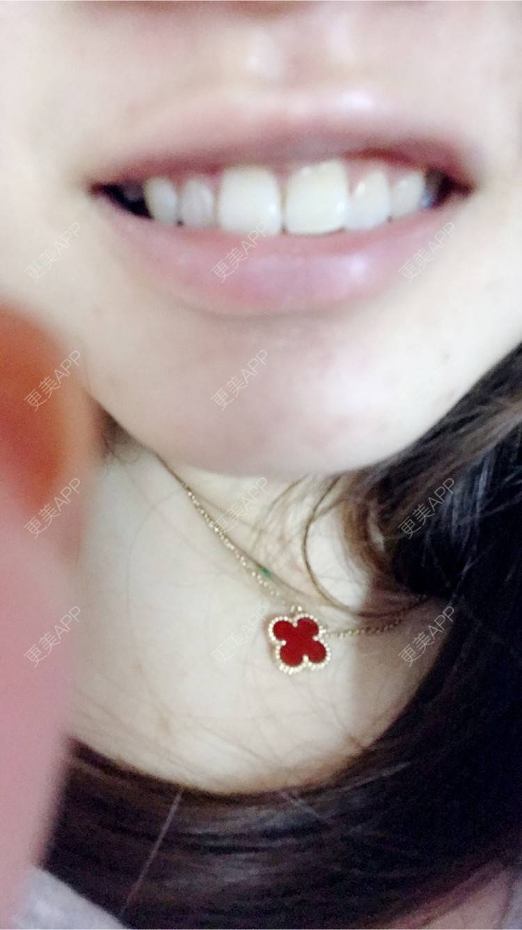 更美 - 更美用户jXjd7AckA8的冷光美白经验 | 上海 | 超声波洗牙
