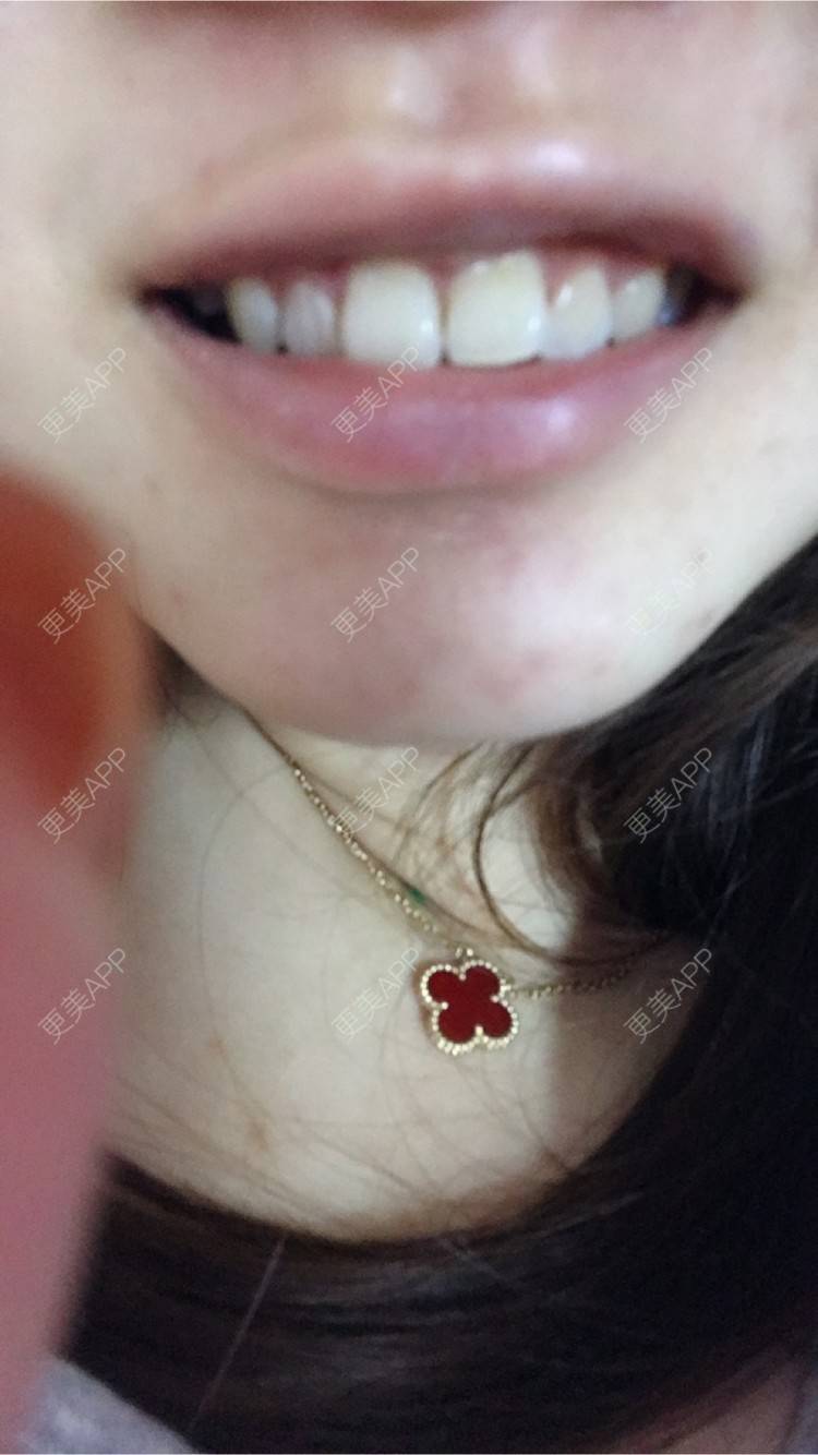 更美 - 更美用户jXjd7AckA8的冷光美白经验 | 上海 | 超声波洗牙