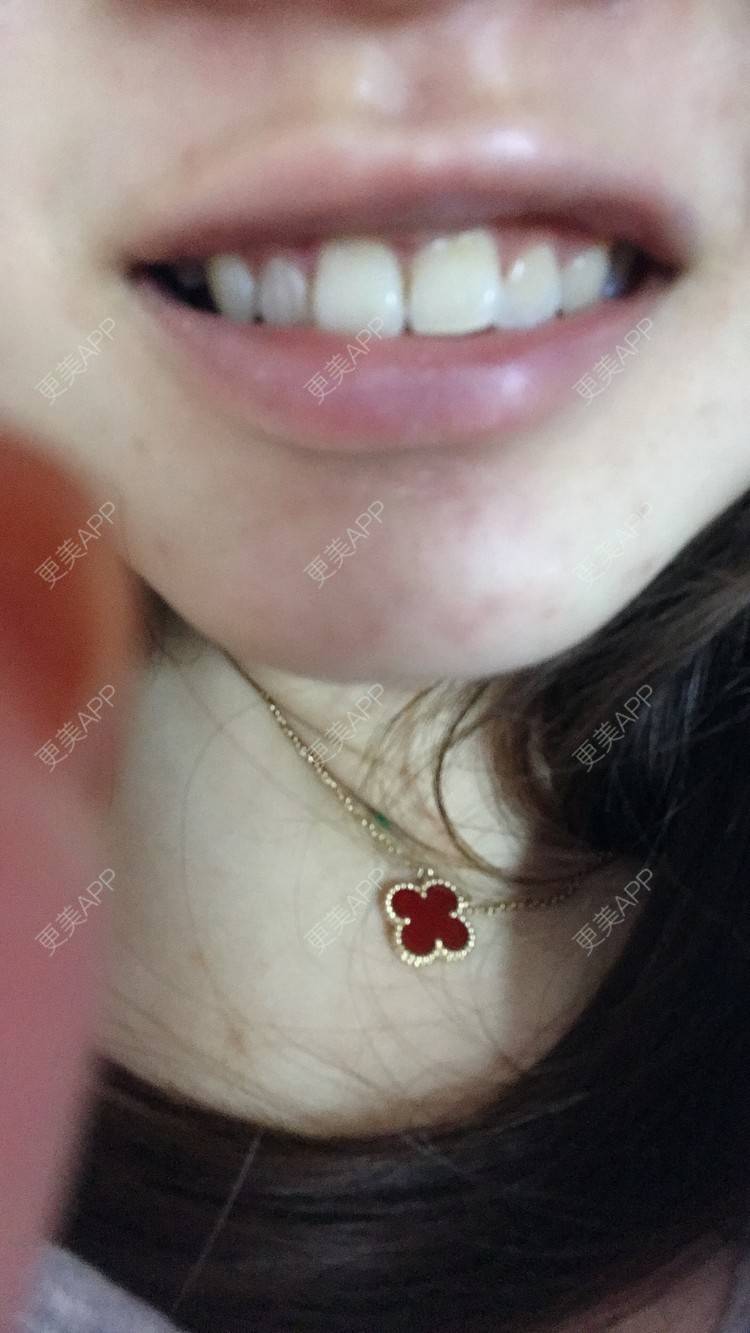 更美 - 更美用户jXjd7AckA8的冷光美白经验 | 冷光美白 | 上海 | 超声波洗牙