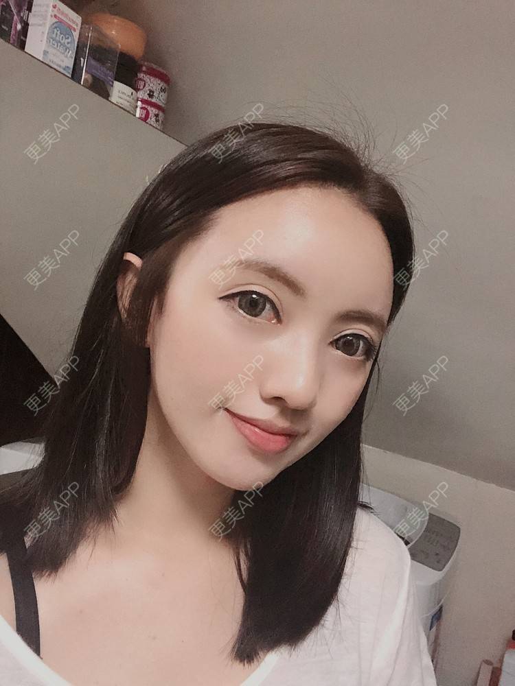 更美 - S666的自体脂肪全面部填充经验 | 南京 | 自体脂肪全面部填充