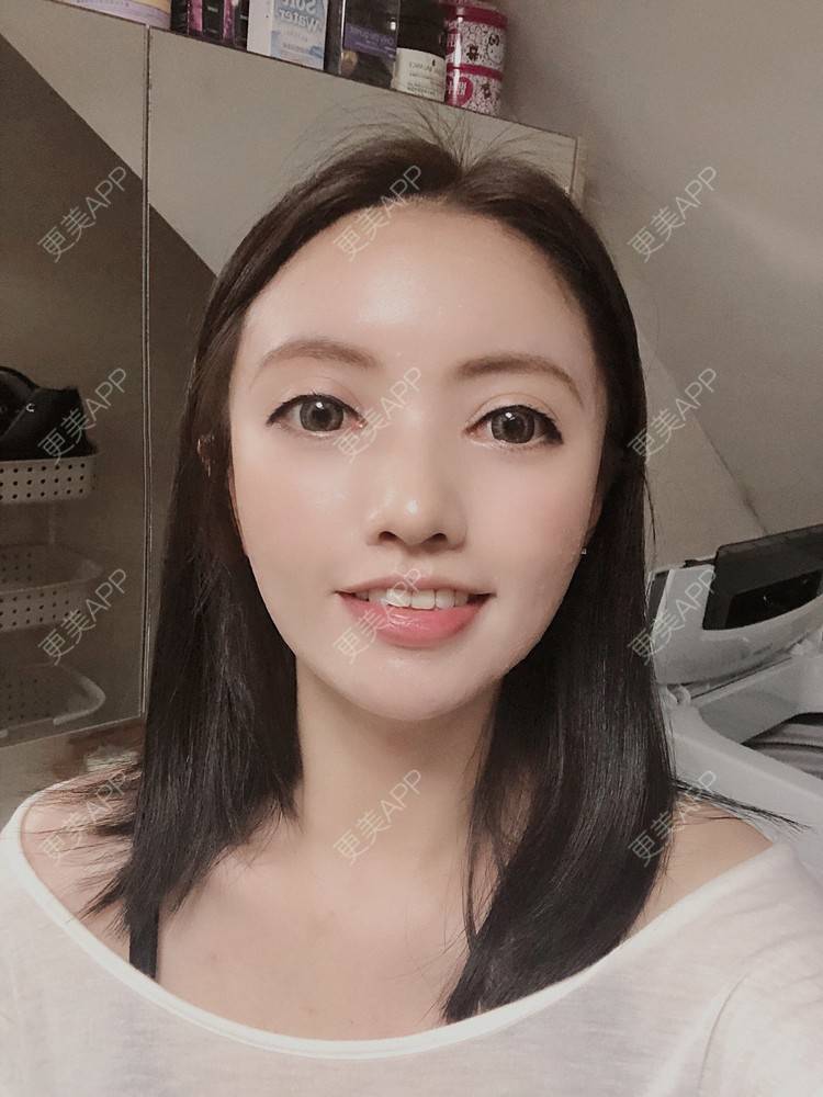 更美 - S666的自体脂肪全面部填充经验 | 南京 | 自体脂肪全面部填充