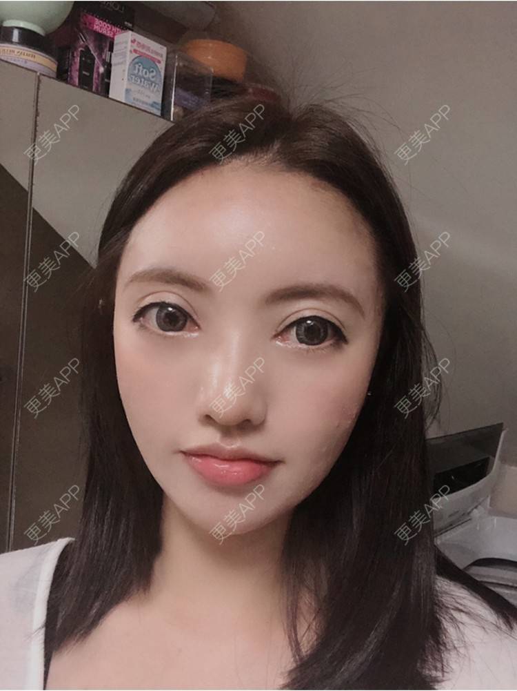 更美 - S666的自体脂肪全面部填充经验 | 南京 | 自体脂肪全面部填充