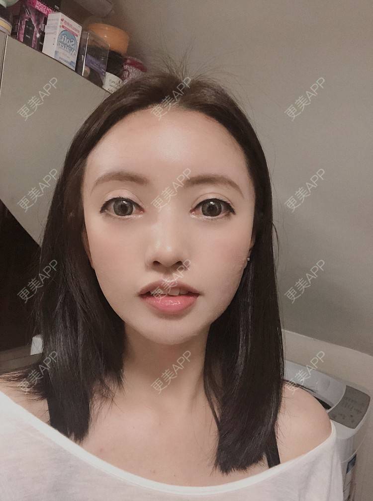 更美 - S666的自体脂肪全面部填充经验 | 南京 | 自体脂肪全面部填充