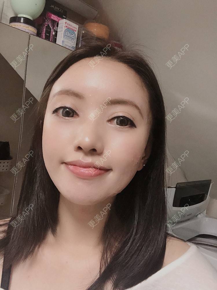 更美 - S666的自体脂肪全面部填充经验 | 南京 | 自体脂肪全面部填充