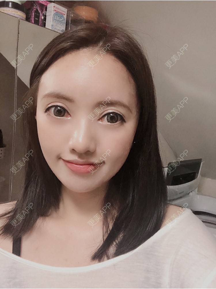 更美 - S666的自体脂肪全面部填充经验 | 南京 | 自体脂肪全面部填充