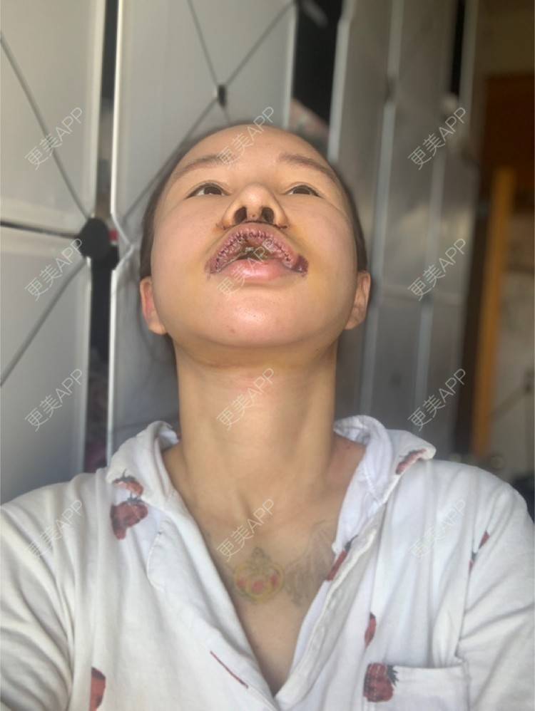 嘤嘤怪wly的厚唇改薄术日记