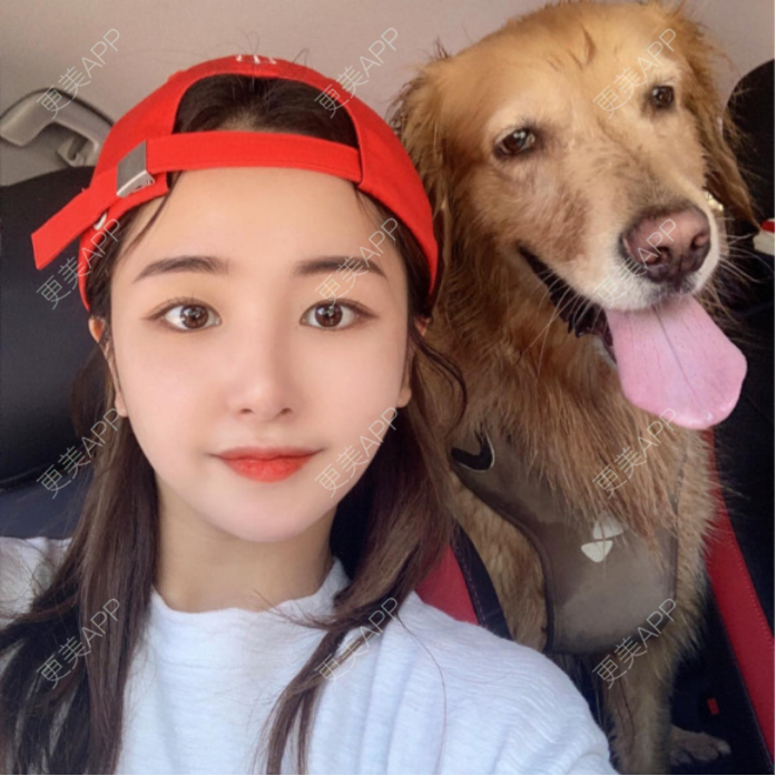 更美 - 微尔的自体脂肪垫下巴经验 | 鼻形态修复 | 颧骨填充 | 下颌角切除 | 自体脂肪垫下巴