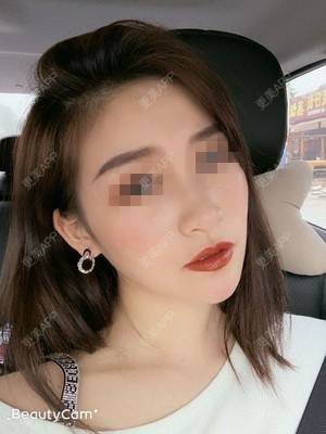 更美 - 看看介绍的自体脂肪丰面颊经验 | 更美研究所 | 自体脂肪全面部填充 | 杭州 | 自体脂肪丰面颊