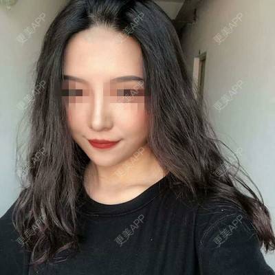 更美 - 小翘比较的经验 | 更美研究所 | 杭州 | 自体脂肪丰面颊