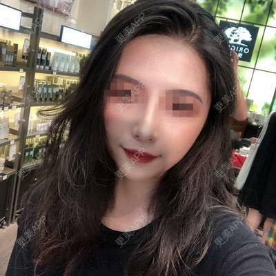 更美 - 小翘比较的经验 | 更美研究所 | 杭州 | 自体脂肪丰面颊