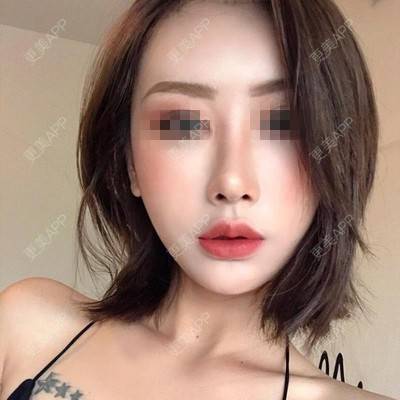更美 - Zvkk的经验 | 更美研究所 | 杭州 | 自体脂肪全面部填充