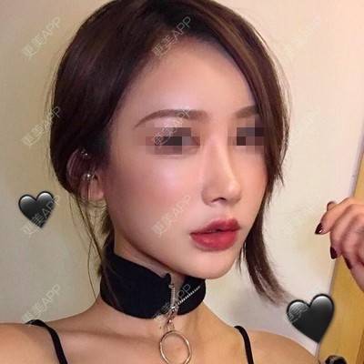 更美 - Zvkk的经验 | 更美研究所 | 杭州 | 自体脂肪全面部填充