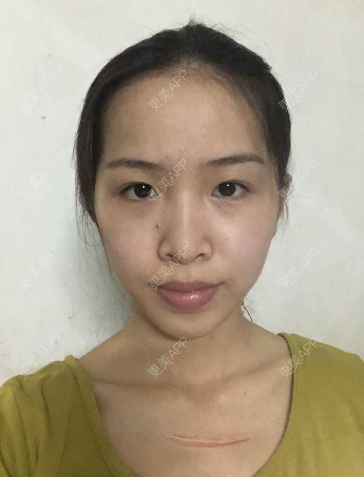 更美 - 蛊惑人心※迅的激光淡疤经验 | 激光淡疤 | 注射淡疤 | 成都