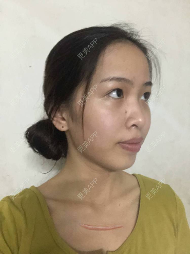 更美 - 蛊惑人心※迅的激光淡疤经验 | 激光淡疤 | 注射淡疤 | 成都