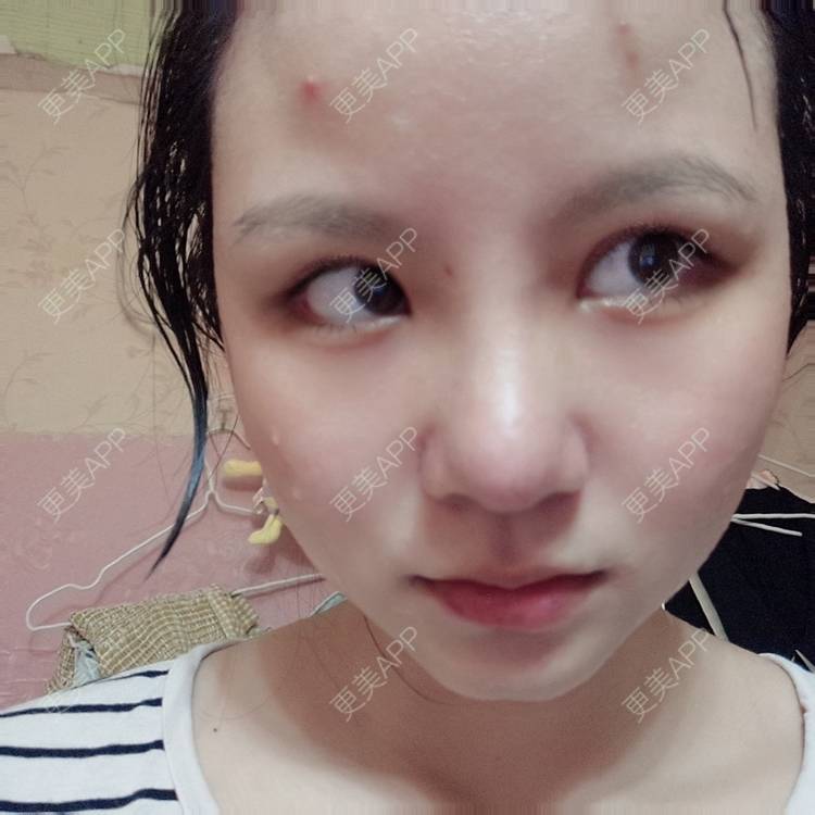 更美 - 更美用户GYLGovg47E的硅胶隆鼻经验 | 硅胶隆鼻 | 郑州