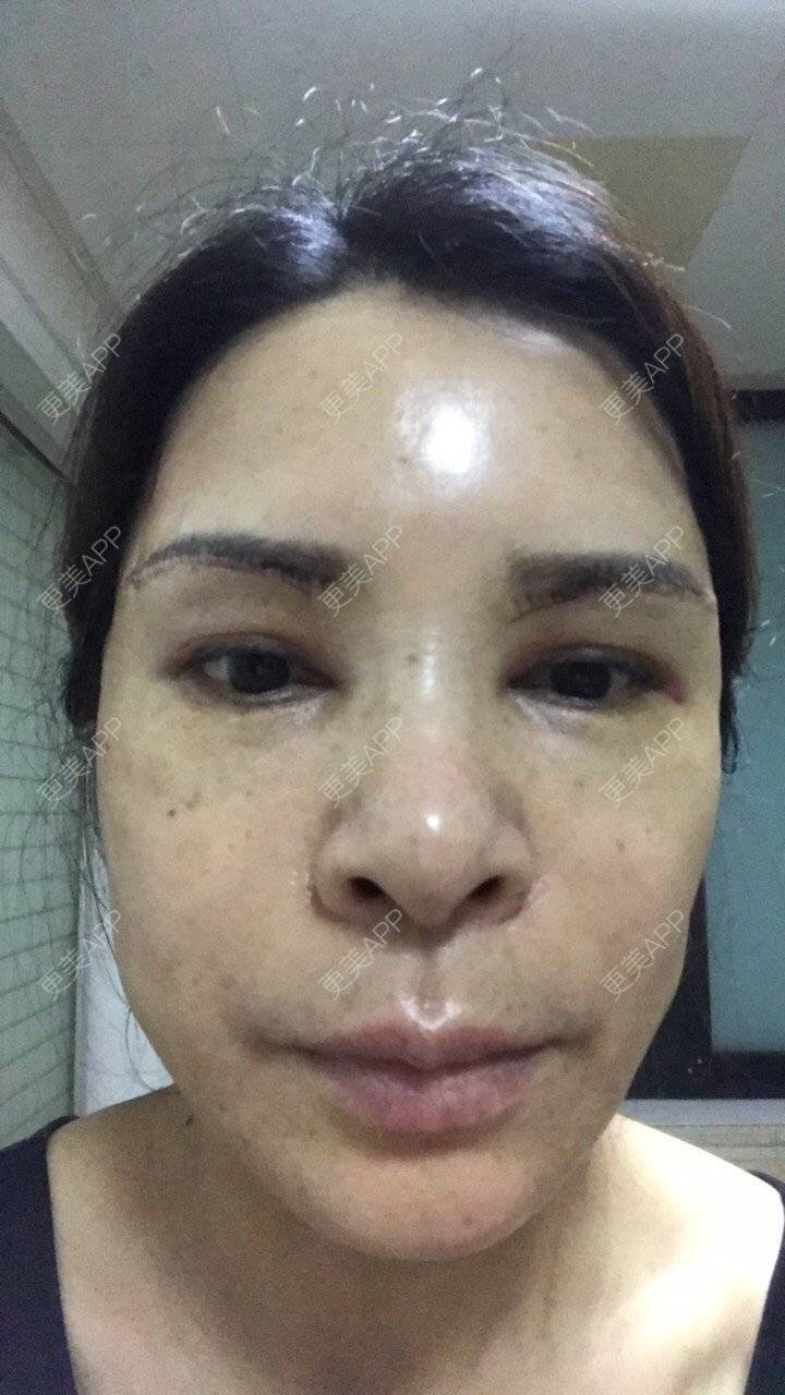 更美 - 雪莲big的眼皮下垂矫正经验 | 提眉修复 | 卧蚕修复 | 双眼皮修复 | 开眼角修复 | 眼袋修复 | 眼皮下垂矫正 | 切眉 | 杭州