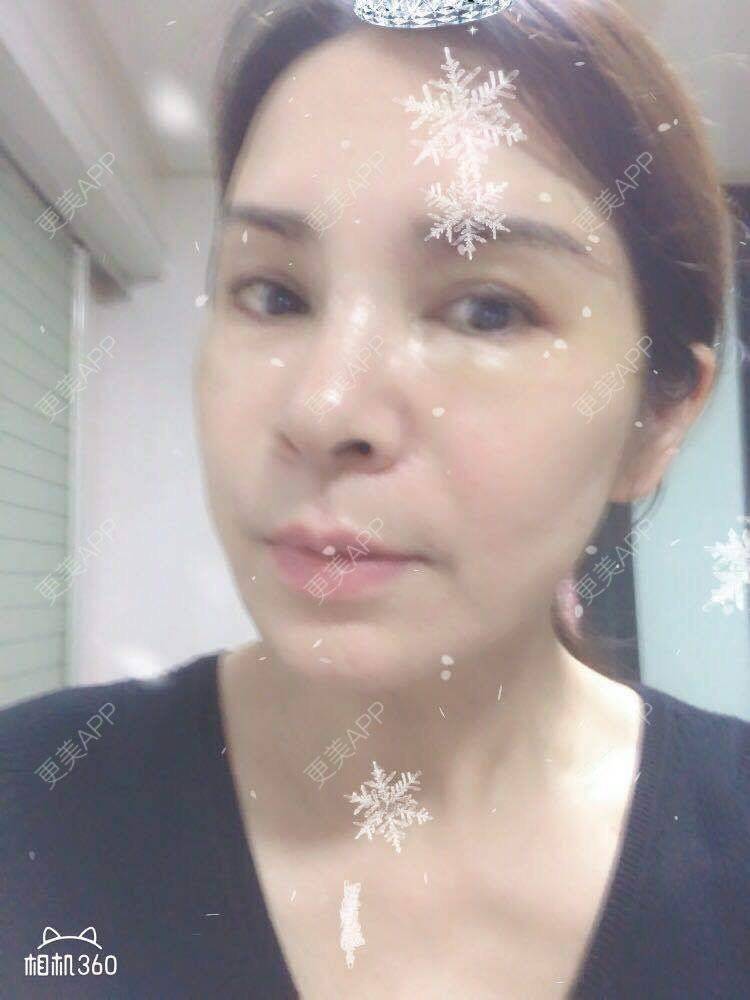 更美 - 雪莲big的眼皮下垂矫正经验 | 眼皮下垂矫正 | 切眉 | 双眼皮修复 | 眼袋修复 | 开眼角修复 | 提眉修复 | 卧蚕修复 | 杭州