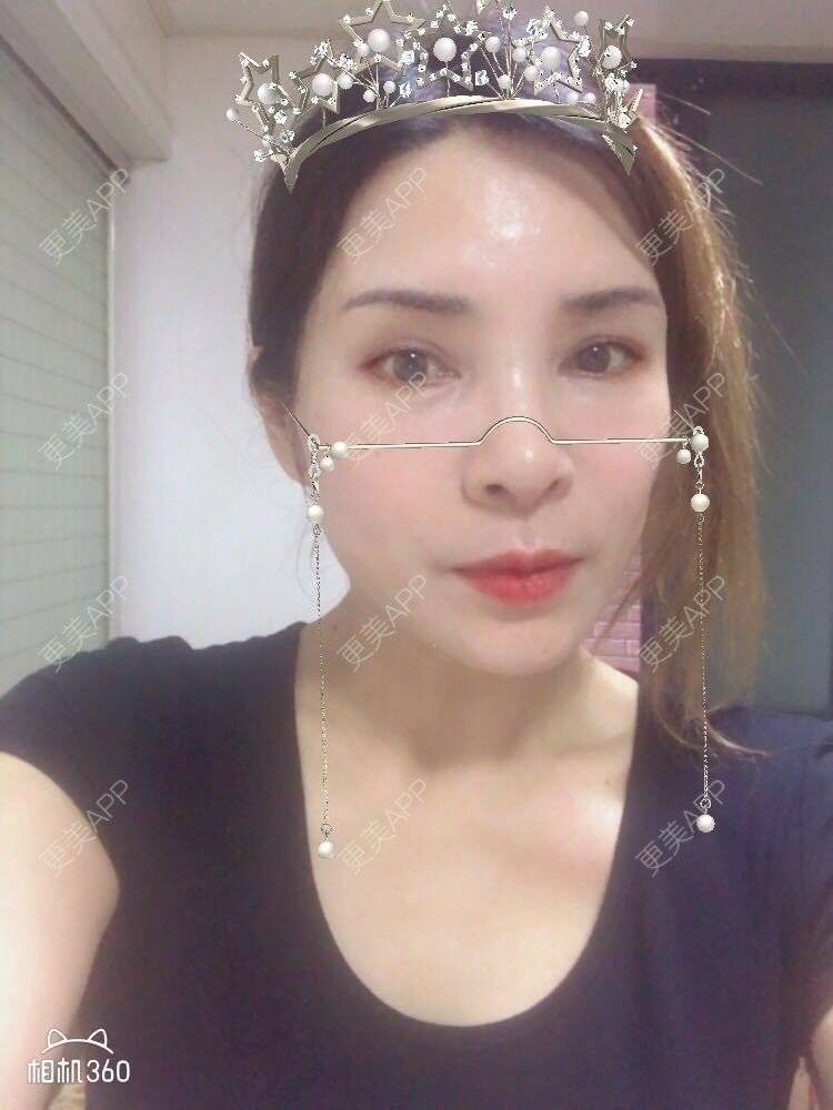 更美 - 雪莲big的眼皮下垂矫正经验 | 眼皮下垂矫正 | 切眉 | 双眼皮修复 | 眼袋修复 | 开眼角修复 | 提眉修复 | 卧蚕修复 | 杭州