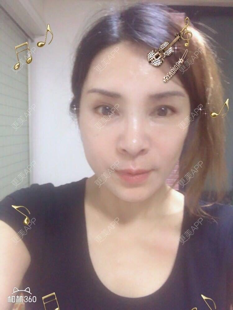 更美 - 雪莲big的眼皮下垂矫正经验 | 眼皮下垂矫正 | 切眉 | 双眼皮修复 | 眼袋修复 | 开眼角修复 | 提眉修复 | 卧蚕修复 | 杭州