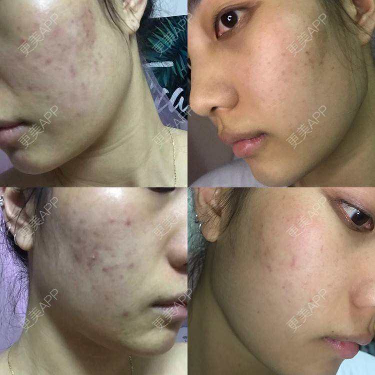 更美 - •你的小可爱•的面部脱毛经验 | 面部脱毛 | 玻尿酸泪沟 | 玻尿酸鼻部 | 玻尿酸下巴 | 深圳